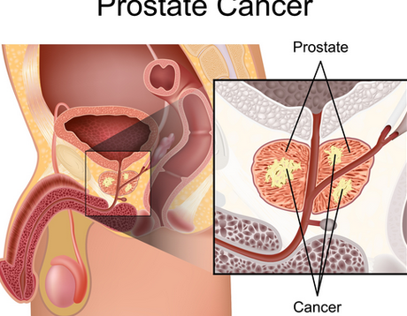 Una Combinacion Agresiva Puede Curar el Cancer de Prostata