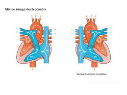 Dextrocardia: síndrome del corazón al revés. Dextrocardia: síndrome del corazón al revés.