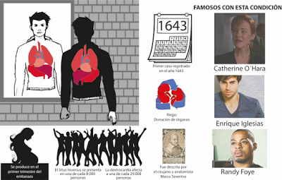 Dextrocardia: síndrome del corazón al revés. Dextrocardia: síndrome del corazón al revés.