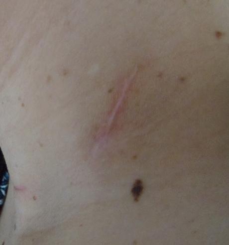 El Antes y el Después de mi Cicatriz tras el Cáncer de Tiroides