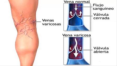 Varices Causas de las varices