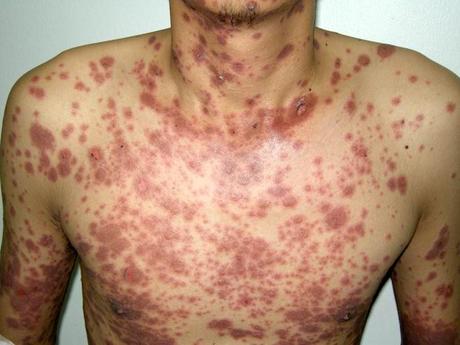 Síndrome de Stevens Johnson (SSJ): síntomas y tratamiento Síndrome de Stevens Johnson (SSJ): síntomas y tratamiento