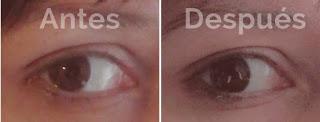 eye lifting formula antes y despues