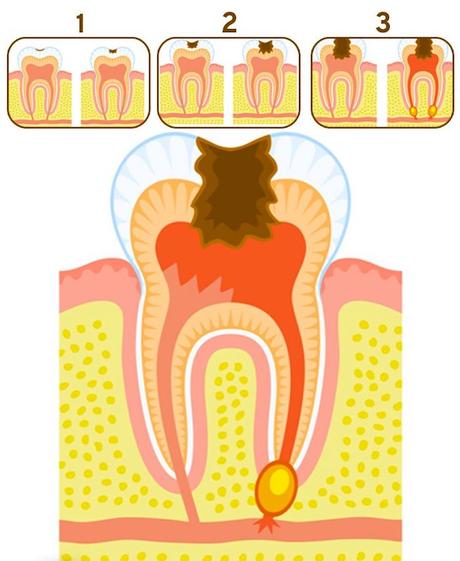 Tratamiento natural para una cavidad “ligera” Tratamiento natural para una cavidad