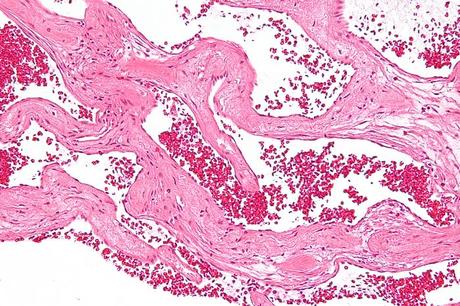 El hemangioma hepático es un tumor benigno