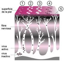 Evolución del herpes zóster