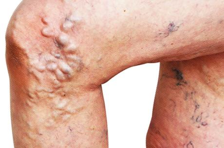 Gemorroidalnyy la trombosis al embarazo