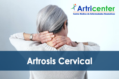 Síntomas de la Artrosis Cervical