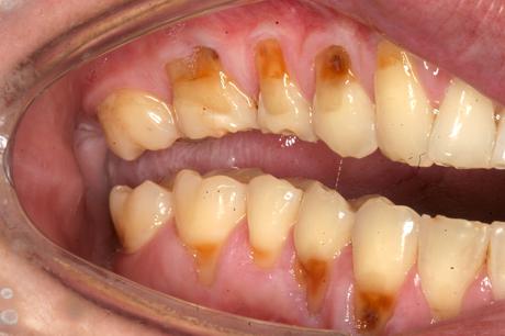 Dientes arruinados por Bulimia: ¿ahora qué? Dientes arruinados por Bulimia: ¿ahora qué?