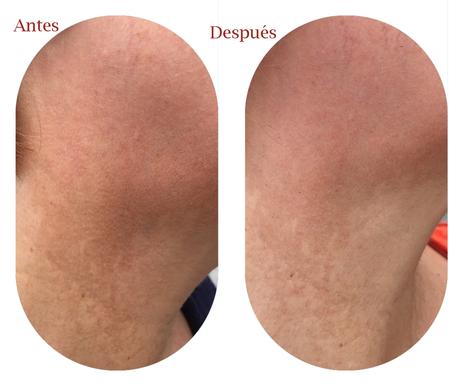 Este es una mancha que me apareció en el cuello hace unos años y que no es muy fácil que se vaya. Experimentando con NeoSkin de Bella Aurora