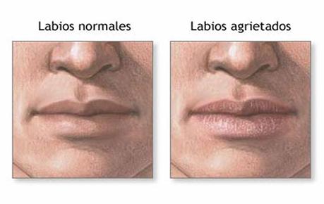 Labios secos y agrietados