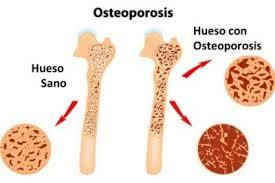 Alimentos ricos en calcio para prevenir o frenar la osteoporosis