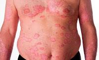 FDA Aprueba Nuevo Medicamento para Tratar la Psoriasis