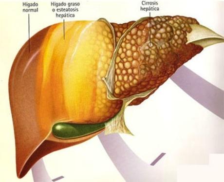 Actualizacion en el Manejo de la Esteatosis Hepatica