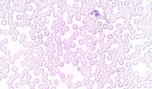 Cómo reducir los leucocitos altos de forma natural Cómo reducir los leucocitos altos de forma natural