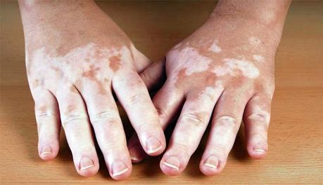 Novedoso Tratamiento para el Vitiligo