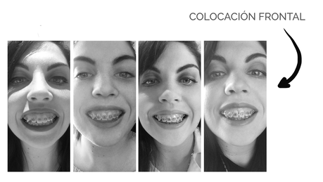 Evolución y resultado de 4 años de ortodoncia