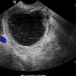 QUISTE DE OVARIO HEMORRAGICO POR ULTRASONIDO