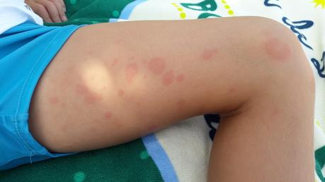 #DaleLaVueltaALaUrticaria Urticaria crónica-caso-paciente-Novartis-AAUC-Madresfera-blog
