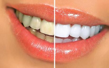 Receta natural para blanquear tus dientes y de paso acabar con la caries y el mal aliento