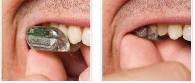 Audífono que se pone entre los dientes Audífono que se pone entre los dientes