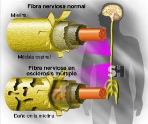 esclerosis multiple Nueva terapia podría mejorar a pacientes de esclerosis múltiple
