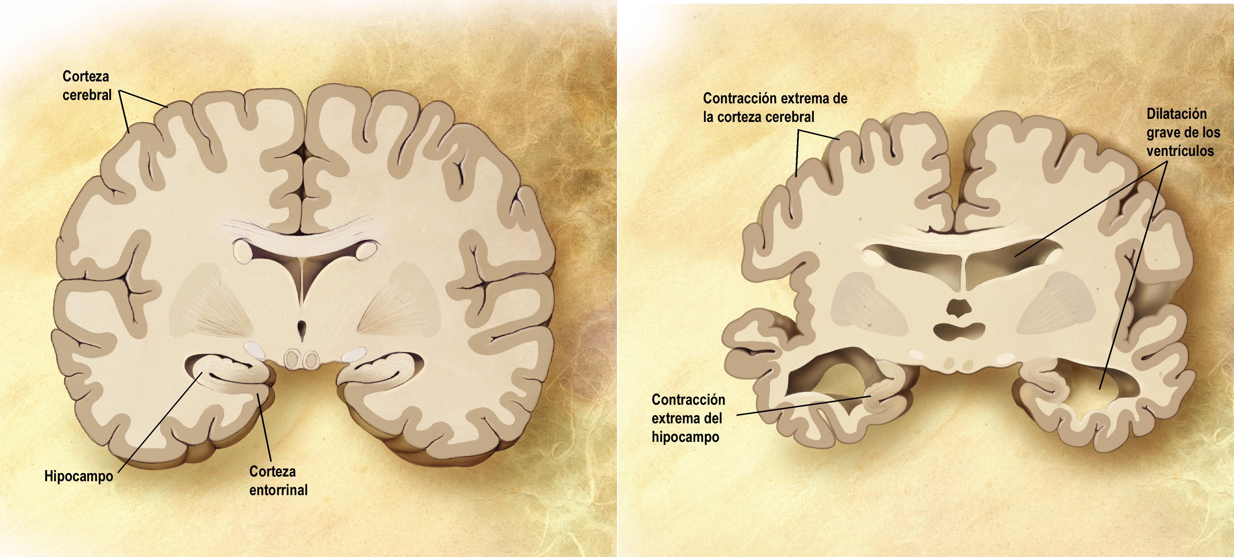 No hay evidencia de que los fármacos retrasen avance neurodegenerativo