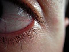 Blefaritis Blefaritis