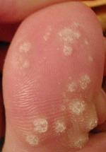 VIRUS DEL PAPILOMA HUMANO O VPH VIRUS DEL PAPILOMA HUMANO O VPH