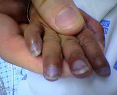 cianosis_bebe Cianosis en bebes