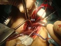 La máquina corazón/pulmón artificial en cirugía cardíaca (anestesia cardiovascular IV)