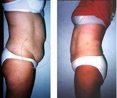 Efectividad de la Hidrolipoclasia Efectividad de la Hidrolipoclasia