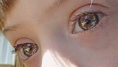 Un experto ahonda en el binomio síndrome de Down- Alzhéimer Un experto ahonda en el binomio síndrome de Down- Alzhéimer