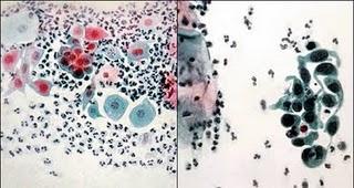 Cáncer de cérvix Cáncer de cérvix