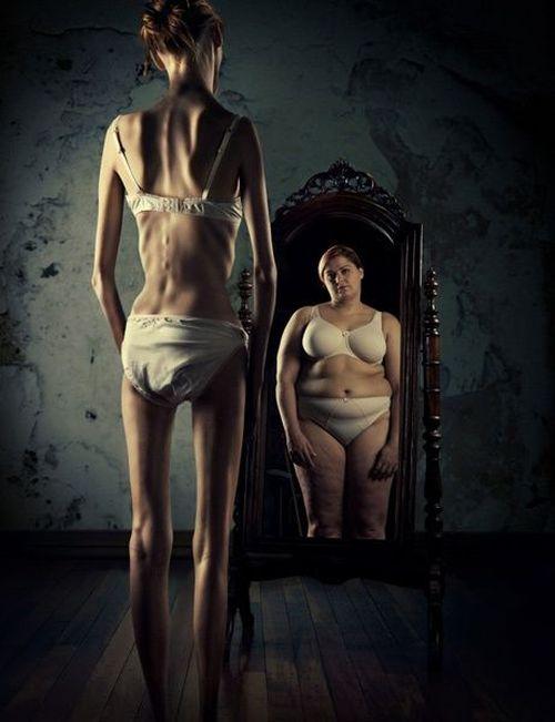 Anorexia Excelente Ejemplo de una Distorsión de la Realidad.