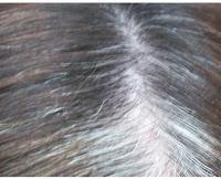 Porque se forman las Canas y su Posible Tratamiento Porque se forman las Canas y su Posible Tratamiento