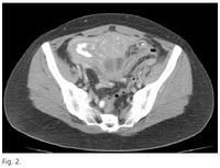 Los Abscesos Pelvicos de Origen Colonico Los Abscesos Pelvicos de Origen Colonico