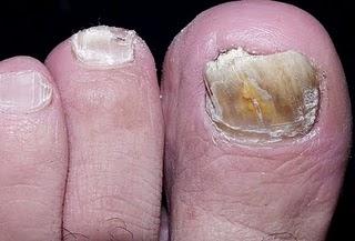 Prednizolon las pastillas la psoriasis