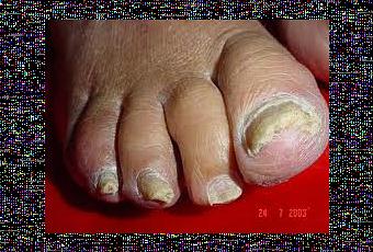 Onicomicosis: la enfermedad de las uñas - Paperblog