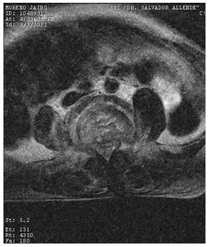 Discitis_Resonancia_Magnetica_RMN/secuencias_t2_axiales2.