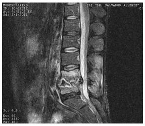 Discitis_Resonancia_Magnetica_RMN/secuencias_tirm_sagitales