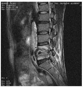 Discitis_Resonancia_Magnetica_RMN/secuencias_t2_sagitales