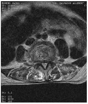 Discitis_Resonancia_Magnetica_RMN/secuencias_t2_axiales