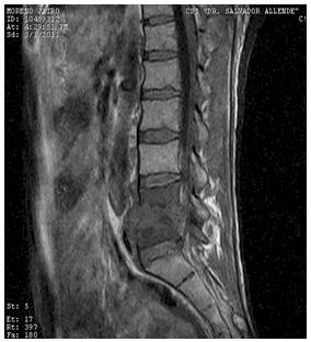 Discitis_Resonancia_Magnetica_RMN/secuencias_t1_sagitales2