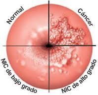 neoplasia cervical intraepitelial Tratamiento de neoplasia cervical intraepitelial ¿podría dar lugar a no tener hijos o partos prematuros?