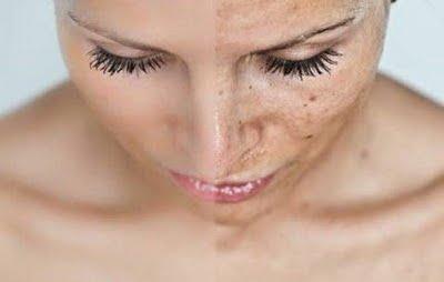 Manchas oscuras en la piel del rostro? Soluciones! Manchas oscuras en la piel del rostro? Soluciones!