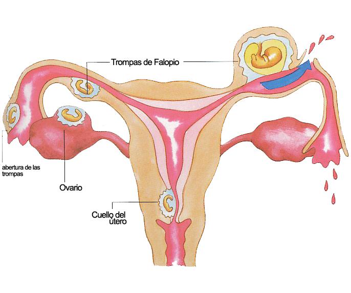 Embarazo ectopico Puebla Dr Benjamin Gloria