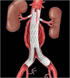 REPARADO UN ANEURISMA DE AORTA ABDOMINAL EN UN PACIENTE CON EPOC SEVERA CON UNA ENDOPRÓTESIS FENESTRADA A MEDIDA‏