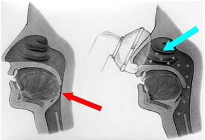 Respuesta a un caso particular de negligencia (10) Respuesta a un caso particular de negligencia (10)