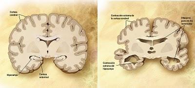 Día internacional del Alzheimer